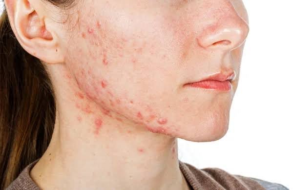 Understanding Acne: Causes and How to Prevent It - BLAKESTORE-NG