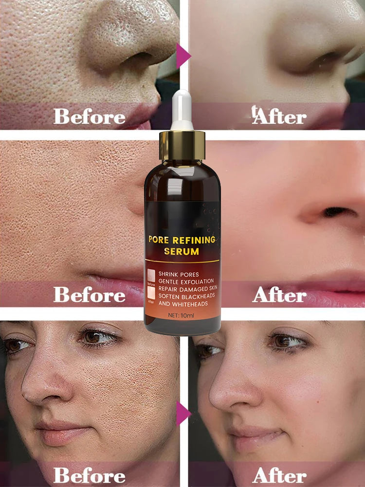 Acne Treatment Anti Aging Serum. - Maison Novaire