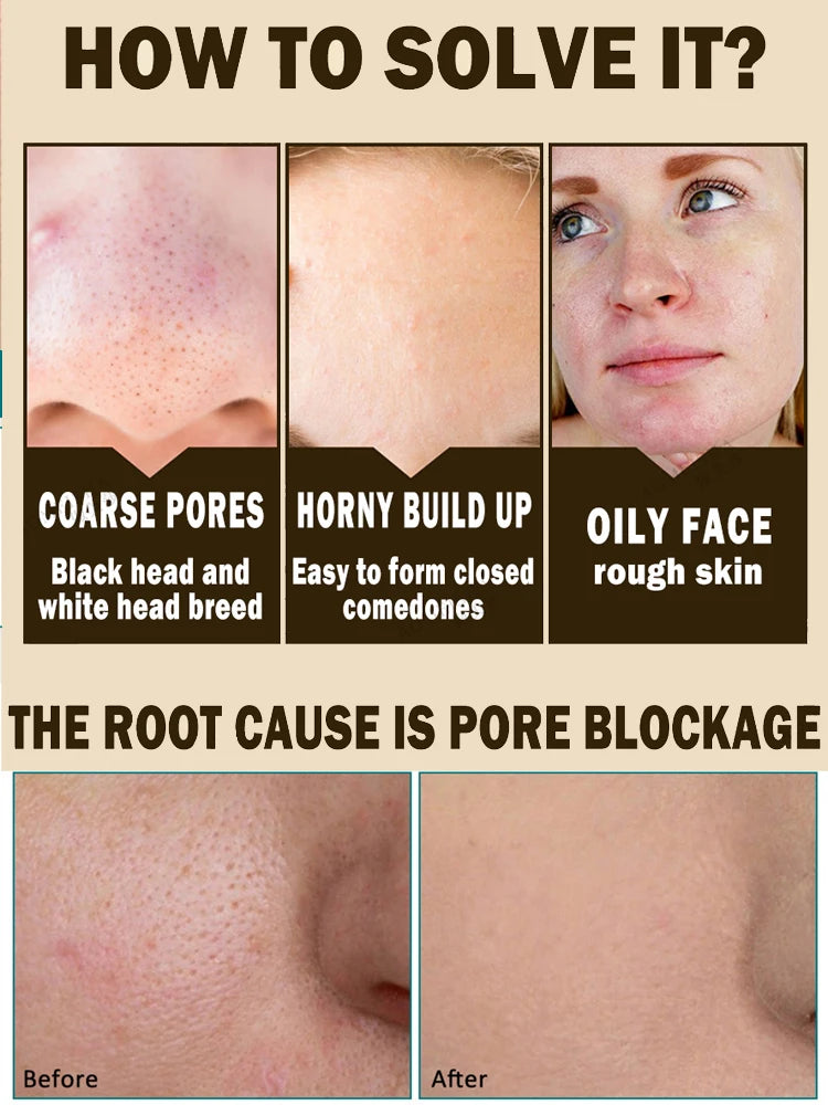 Acne Treatment Anti Aging Serum. - Maison Novaire