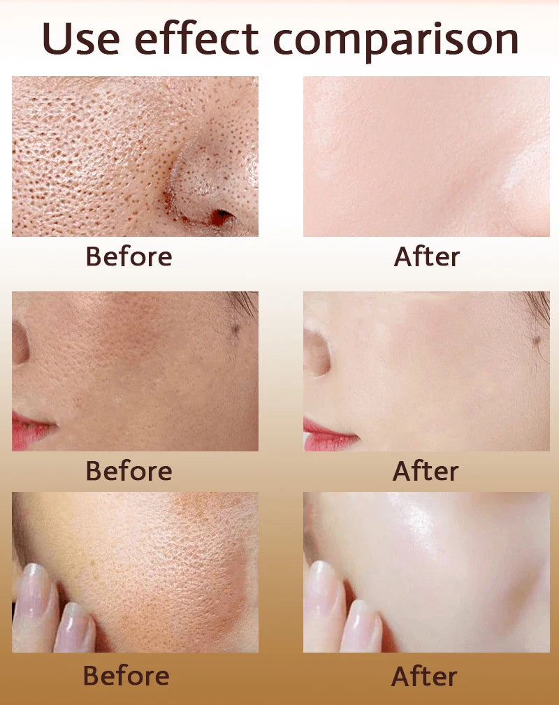 Acne Treatment Anti Aging Serum. - Maison Novaire
