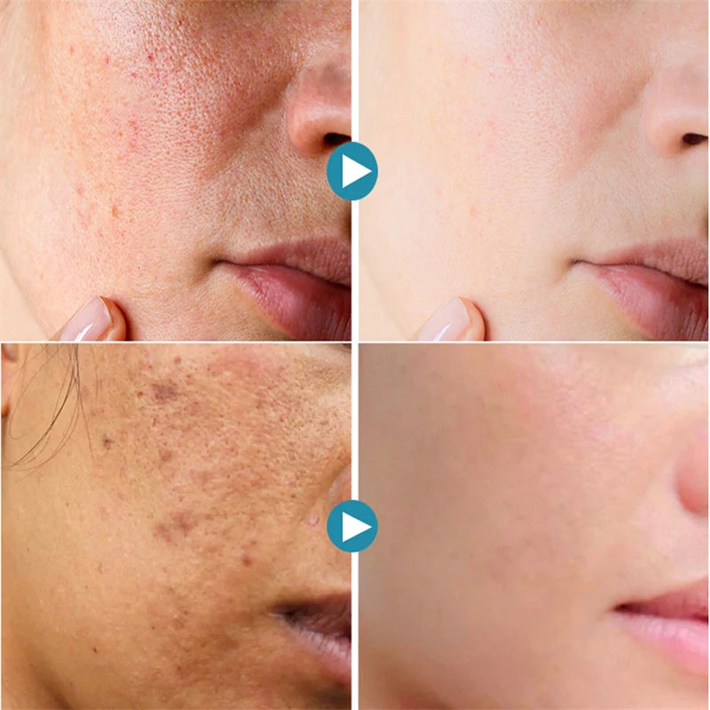 Acne Treatment Anti Aging Serum. - Maison Novaire