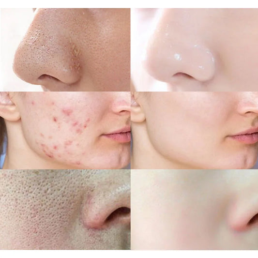 Bubble Mask Face Cleaning for Acne Treatment - Maison Novaire #