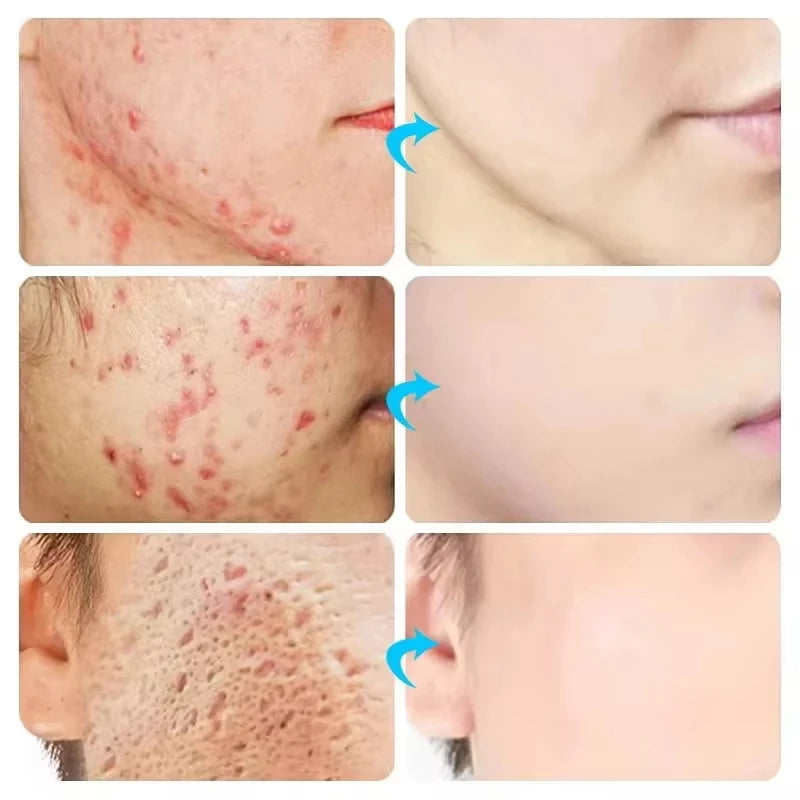 Herbal Acne Removal Face Cream. - Maison Novaire