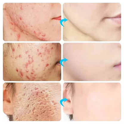Herbal Acne Removal Face Cream. - Maison Novaire