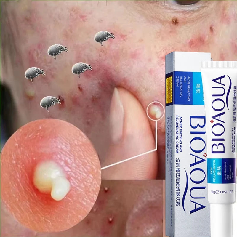 Herbal Acne Removal Face Cream. - Maison Novaire