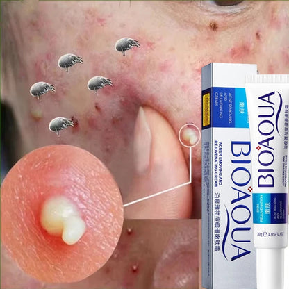 Herbal Acne Removal Face Cream. - Maison Novaire