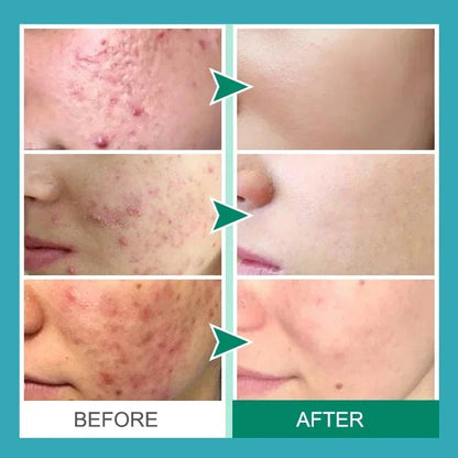 Herbal Acne Removal Face Cream. - Maison Novaire