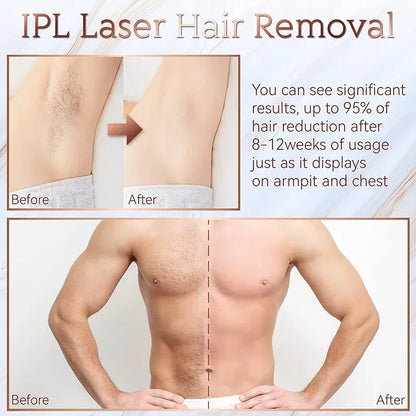 Painless Electric Epilator Laser Hair Removal. - Maison Novaire